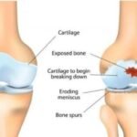 Osteoarthritis Lutut