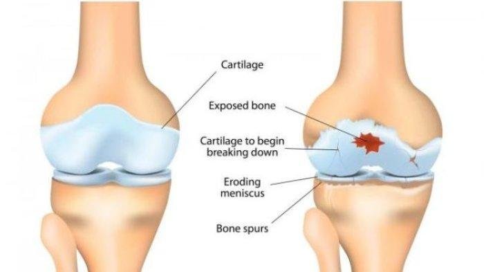 Osteoarthritis Lutut